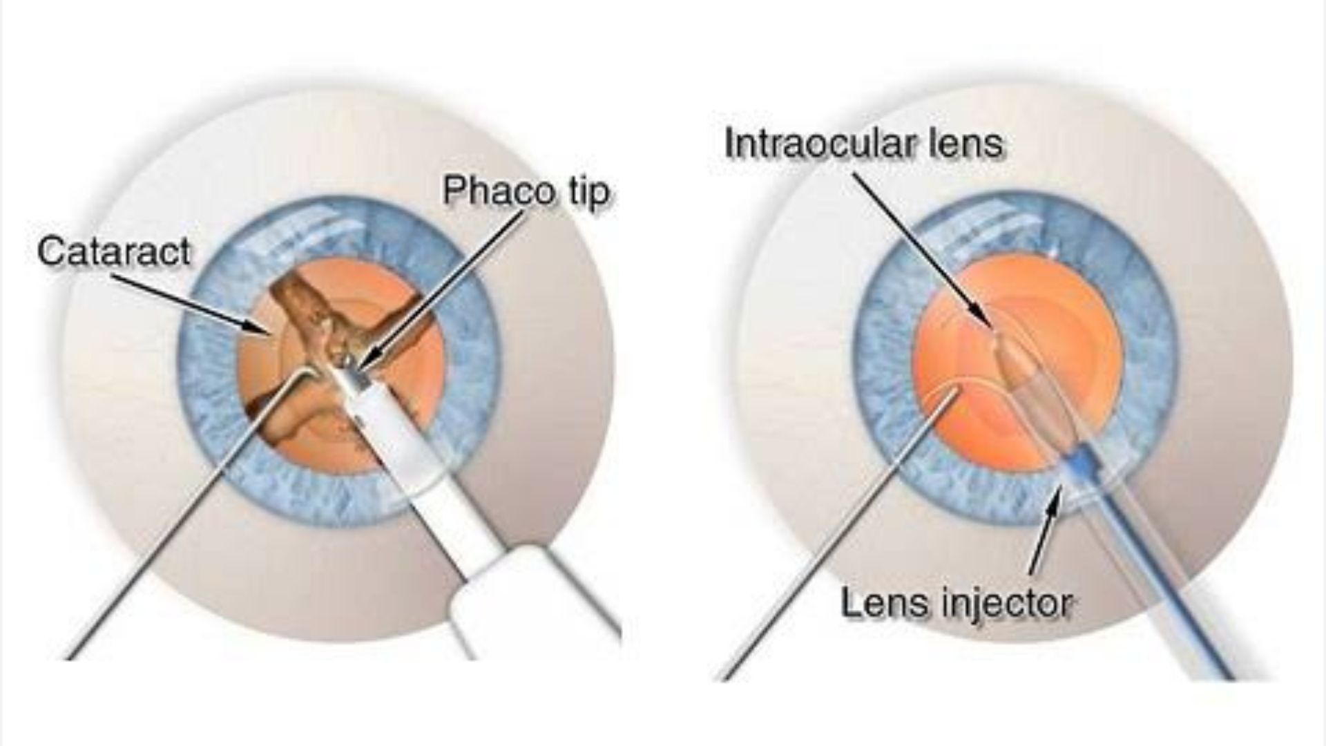 Advanced Eye Clinic Services: What You Need to Know About Advanced Cataract Sergery - Malhar Eye Care Services Pune