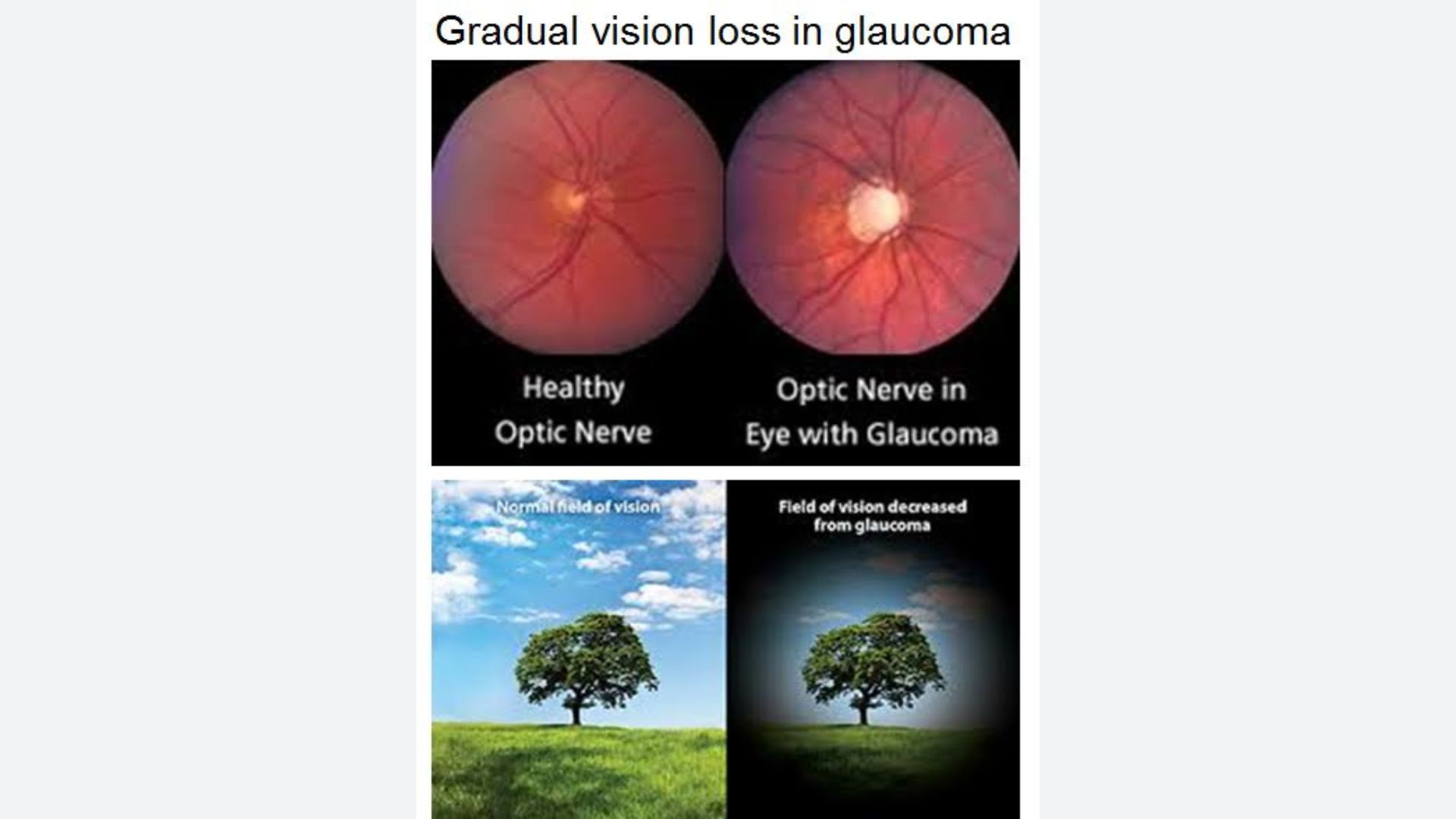 Advanced Eye Clinic Services: What You Need to Know About Glaucoma Evaluation & Management - Malhar Eye Care Services Pune