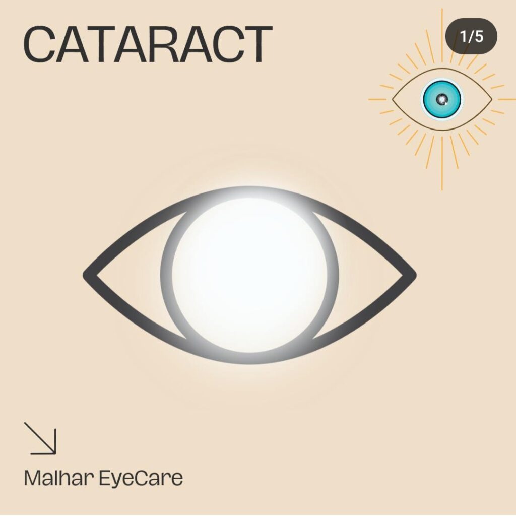 cataract eye surgery